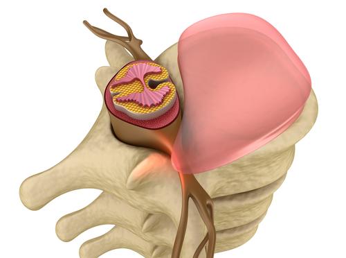 HERNIATED DISC